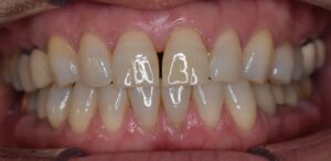 前歯のすきっ歯（正中離開）の症例