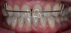 前歯のすきっ歯（正中離開）治療中の症例