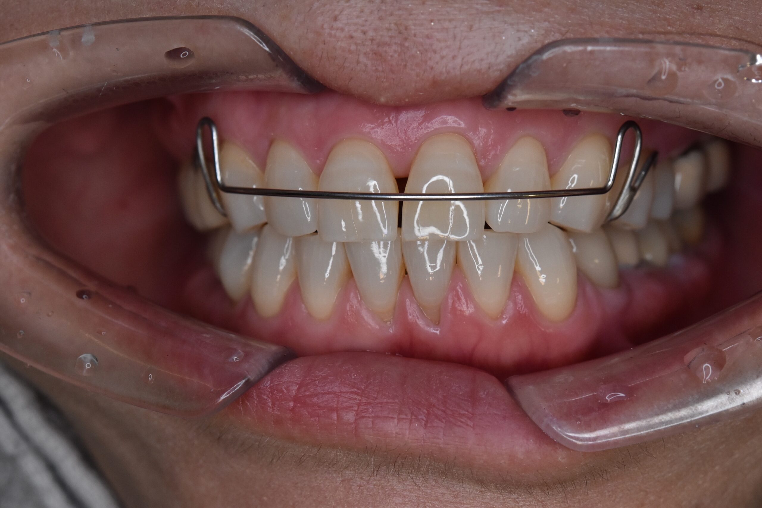 西梅田・北新地のすきっ歯治療｜リテーナー矯正・ダイレクトボンディング・セラミックの違い