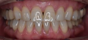 リテーナー治療ですきっ歯を改善した症例