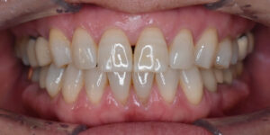 北新地ですきっ歯の改善の術後