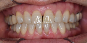 北新地ですきっ歯の改善の術前