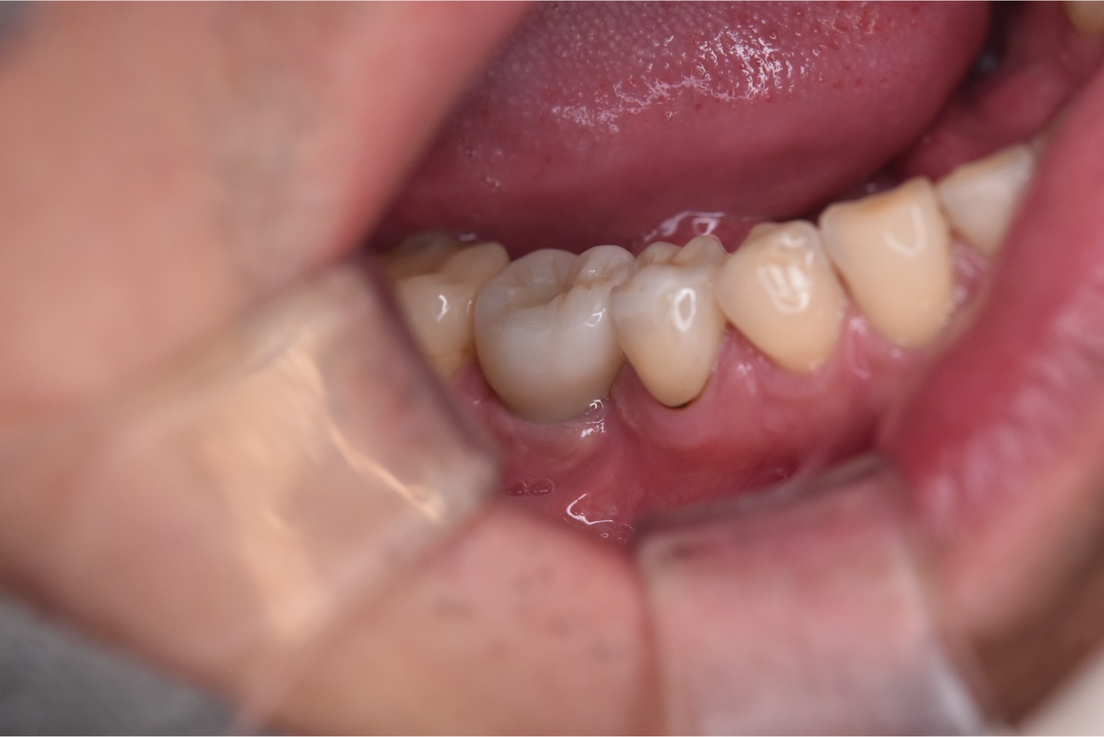 40代のインプラント治療後の口腔内写真