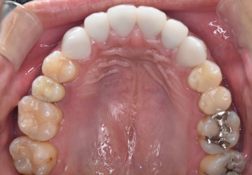 インプラント症例（20代男性）左上奥歯の治療後。隣の歯を削らず補綴した状態