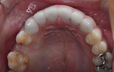 インプラント症例（20代男性）左上奥歯の術前口腔内写真。違和感と痛みがあったケース