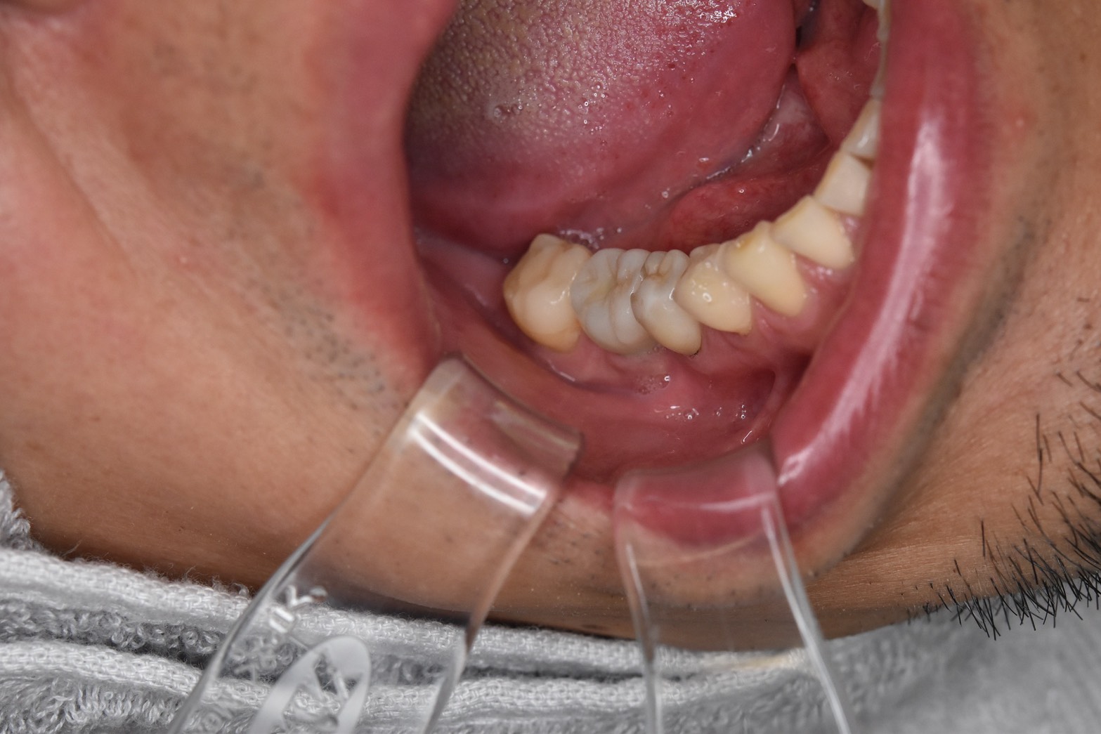 インプラント症例（60代男性）治療後の口腔内写真。インプラントにより欠損部を補綴した状態