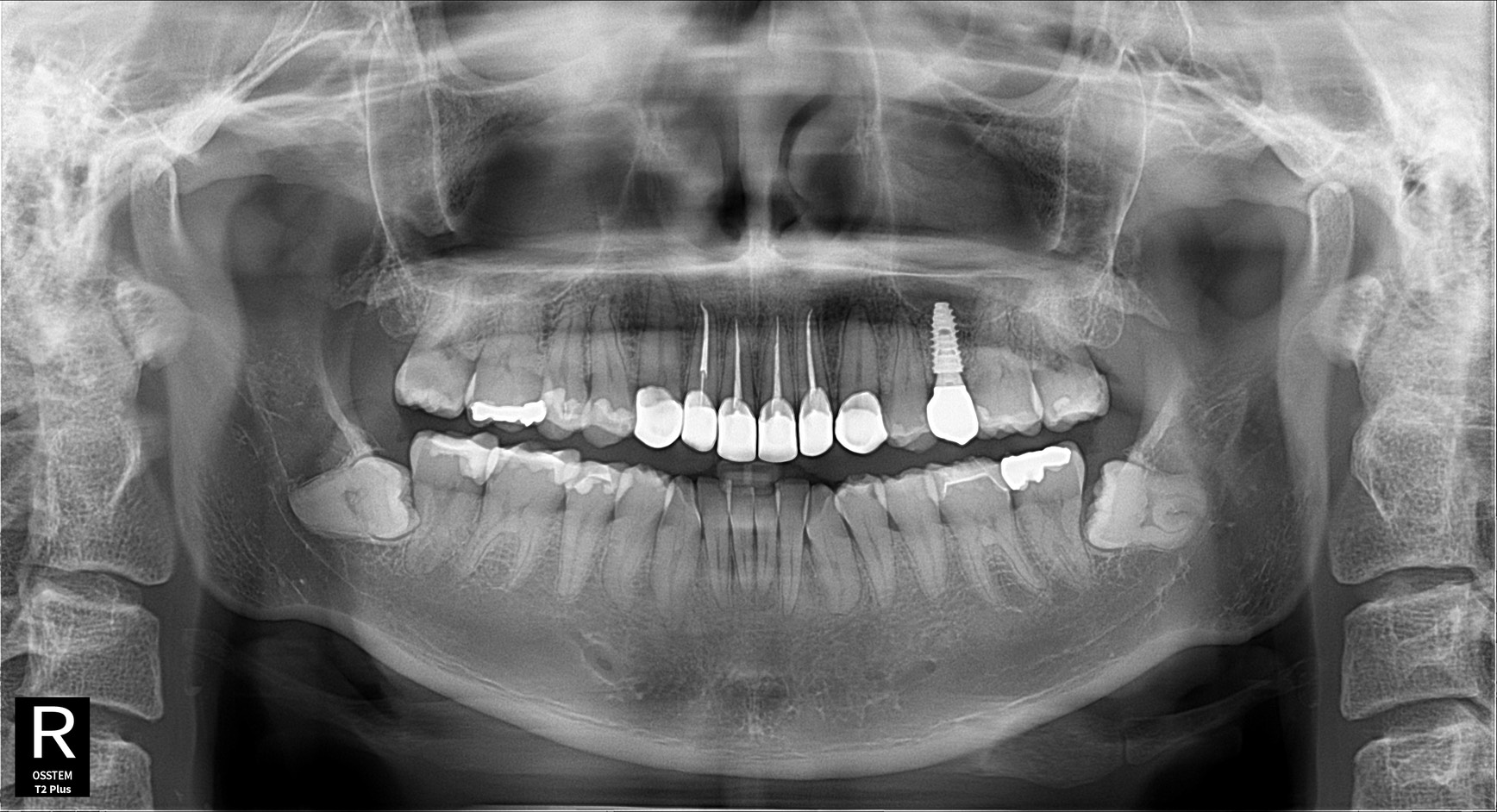 インプラントは本当に痛い？北新地の歯科医が正直に解説