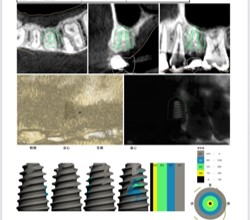 北新地で精密インプラント治療なら｜CT・ガイド手術による安全で正確な治療