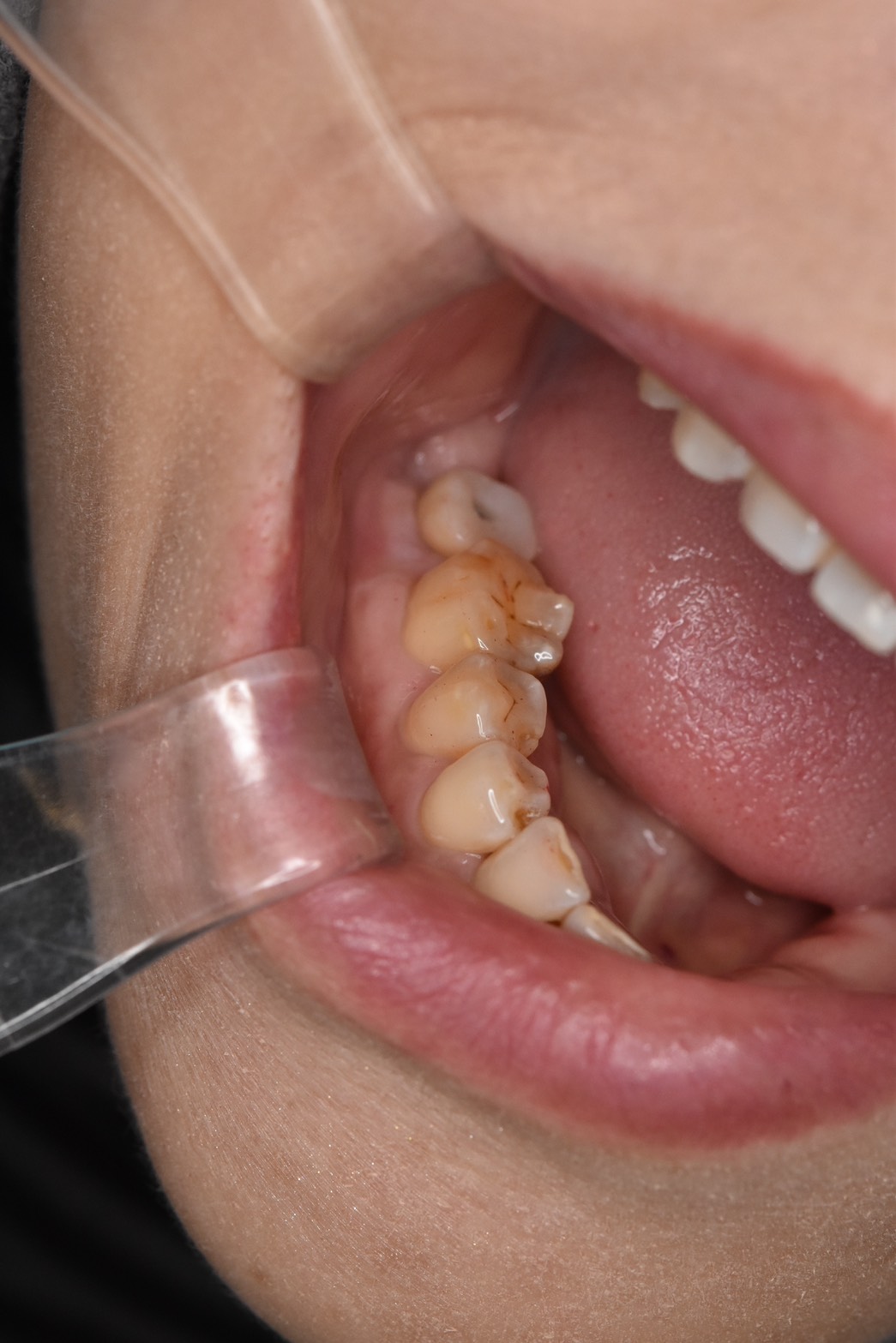 インプラント症例（60代以上、術後）下顎左側の口腔内写真。補綴物の高さが対顎との噛み合わせで調整された状態