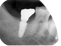 インプラント症例（60代以上、術後）下顎左側にインプラントと補綴装着後のレントゲン