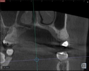 「北新地の歯科医院で行うインプラント治療のCT診断」
