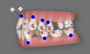 インビザライン治療前後の歯並びシミュレーション｜北新地の矯正治療