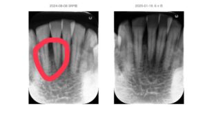 北新地での歯周病治療後の口腔内写真|炎症が改善し歯周組織が安定した状態