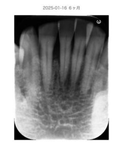 北新地での歯周病治療後の口腔内写真|炎症が改善し歯周組織が安定した状態