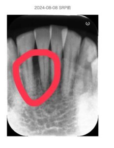 北新地での歯周病治療前の口腔内写真|歯ぐきの腫れと炎症が見られる状態