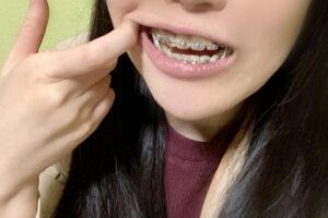 北新地・堂島で行うワイヤー矯正の装置装着写真