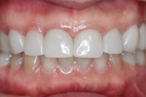 西梅田でのジルコニアクラウン治療後の自然な仕上がり