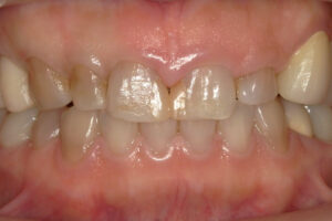 西梅田でのジルコニアクラウン治療前の前歯