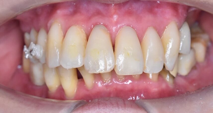 60代女性審美治療前の歯写真（正面）