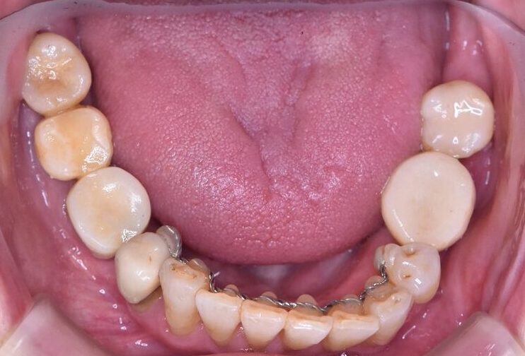 60代女性審美治療前の歯の写真（下顎）