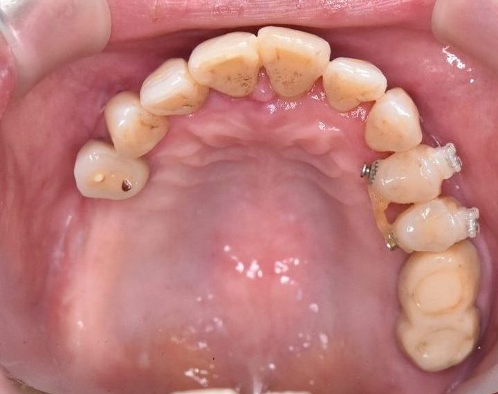 60代女性 審美治療前の歯の写真（下顎）