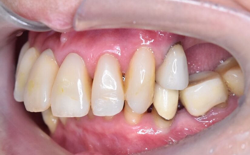 60代女性 審美治療前の歯の写真（左側方）