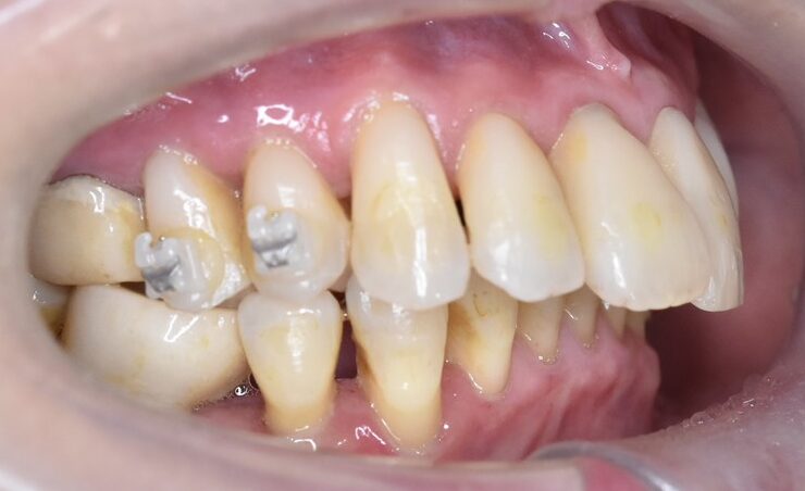 60代女性 審美治療前の歯の写真（右側方）