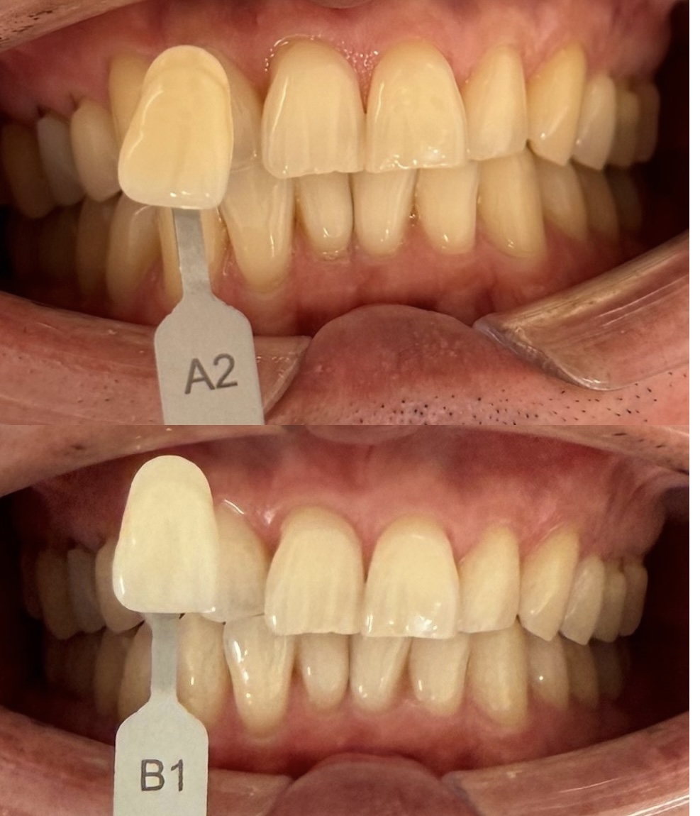 30代男性のホワイトニング症例｜清潔感・第一印象を高める治療