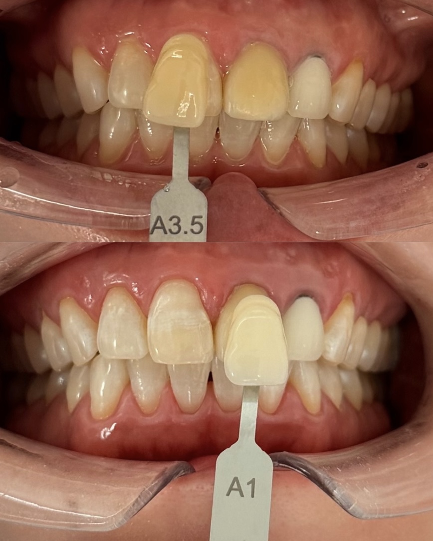 ホワイトニング症例｜A3.5からA1へ｜8トーンアップした症例