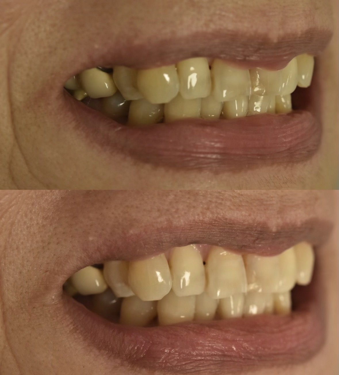北新地でホワイトニング｜60代女性のリタッチで自然に白く若々しい口元へ