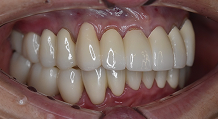 60代女性の治療後の口腔内写真（右側方）