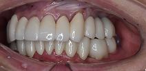 60代女性審美治療後の口腔内写真（左側方