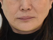 60代女性審美治療の前の写真正面