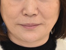 60代女性審美治療の後の写真正面