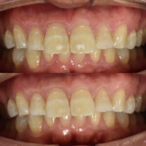 アイコン治療の術前術後30代男性大阪