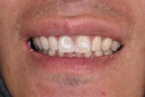 前歯の色のくすみと形の不揃いが気になる症例(ホワイトニング・ダイレクトボンディング後の口元/40代男性・大阪北新地)