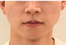 エラボトックスによる食いしばり改善とフェイスラインの変化のビフォー（20代男性）
