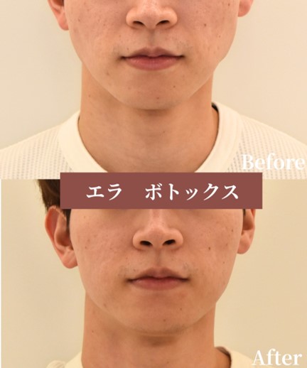 エラボトックスで小顔＆食いしばり改善｜症例紹介（大阪・北新地）