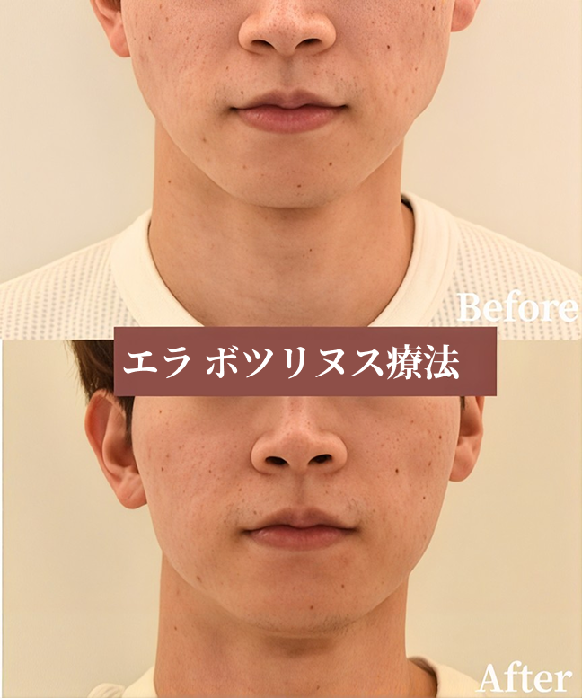 エラ ボツリヌス療法で小顔＆食いしばり改善｜症例紹介（大阪・北新地）