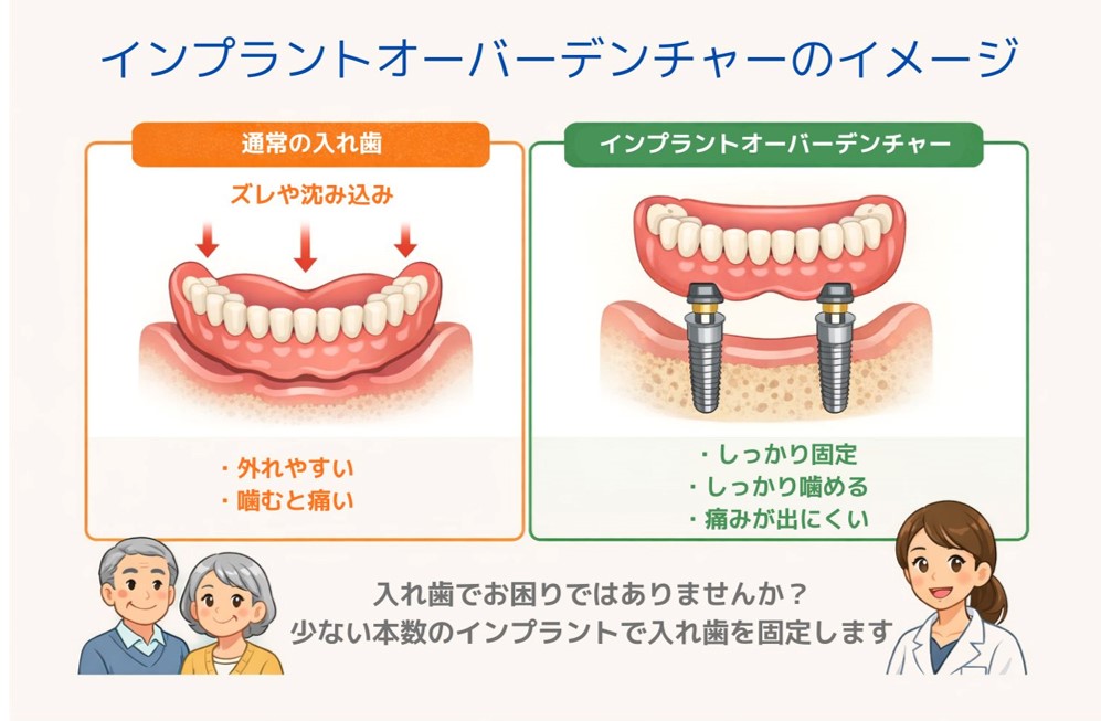 インプラントオーバーデンチャーの構造と通常の入れ歯との違い