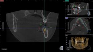 北新地で行うインプラント治療のCT三次元診断画像