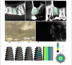 オステムワンガイドによるインプラント埋入設計画面