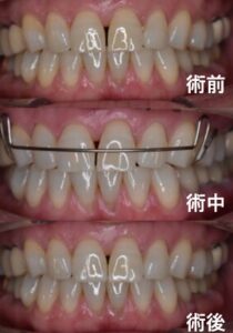短期間2ヶ月で整えた前歯の部分矯正症例