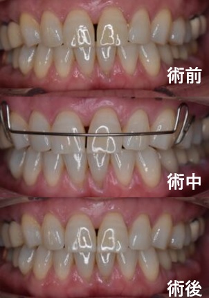 ホワイトニング目的で来院→前歯のすき間を部分矯正で改善｜2ヶ月・2回通院で自然な仕上がりに