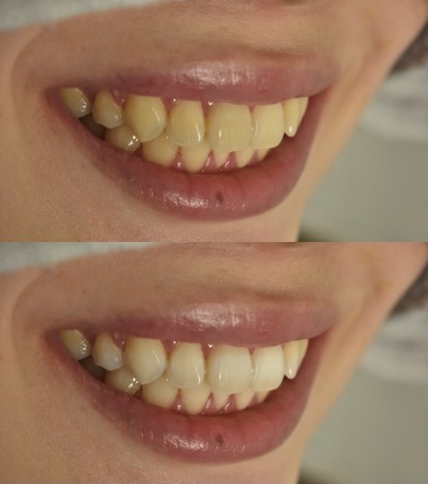 結婚式前にも間に合う？ホワイトニング症例3選｜北新地・大阪