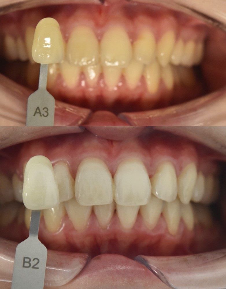 20代女性のホワイトニング前と後の変化、自然な白さの歯