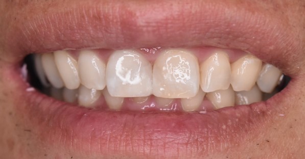 ホワイトニング・ダイレクトボンディング後の前歯の色と形（40代男性・北新地）