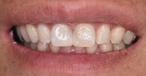 前歯の色のくすみと形の不揃いが気になる症例(ホワイトニング・ダイレクトボンディング後/40代男性・大阪北新地)