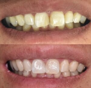 前歯の色のくすみと形の不揃いが気になる症例(ホワイトニング・ダイレクトボンディング前後/40代男性・大阪北新地)