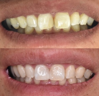 前歯の色と形が気になる方へ｜ホワイトニング＋ダイレクトボンディング症例（40代男性・大阪／北新地）